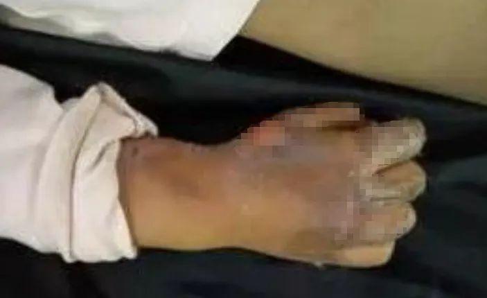 千万远离!手、脸都被烧伤!家中有孩子的要警惕