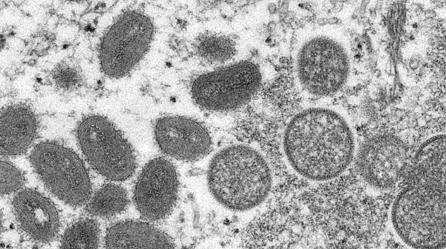多国报告人感染猴痘病毒 猴痘疫情持续扩散