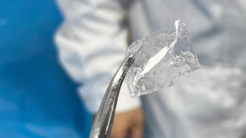 8月龄宝宝误吞塑料膜卡喉！多学科专家联合施救