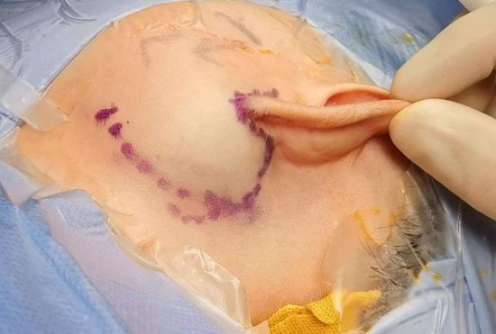 宝宝脸上长“鸽子蛋”肿瘤险致面瘫！毫米级手术保全神经保住笑容