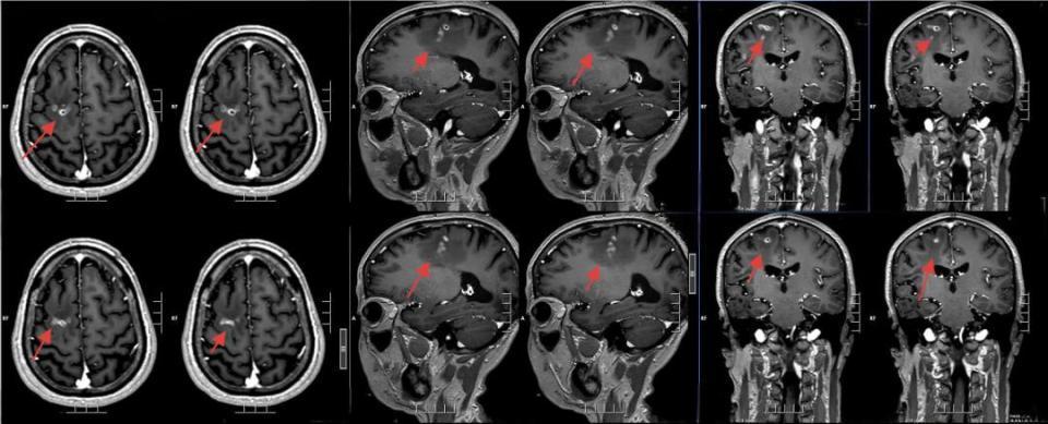寄生虫在脑内“安家”21年！男子不敢独自出门