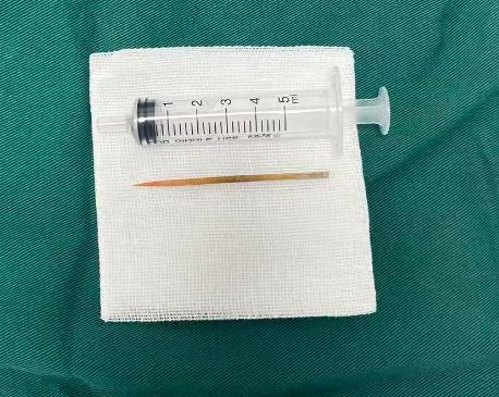 喝水误吞牙签致肠穿孔！广州钟落潭镇卫生院急救化险为夷