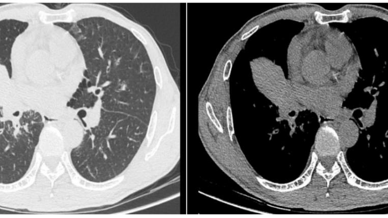 咳嗽三月元凶终现形，番禺中医院医生超声支气管镜精准“缉凶”