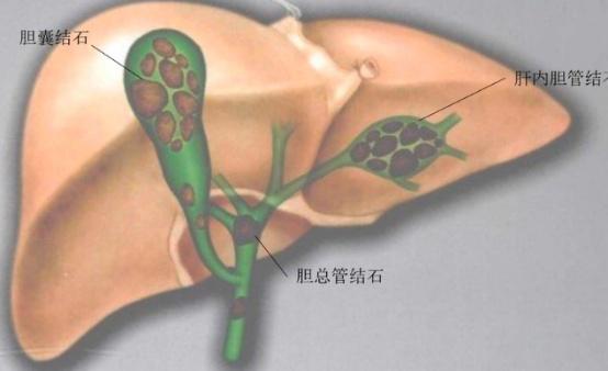 陈科全主任说,目前肝胆管结石最主要和最有效的治疗方式依旧是手术