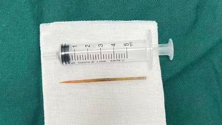 喝水误吞牙签致肠穿孔！广州钟落潭镇卫生院急救化险为夷